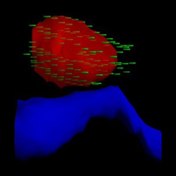 Permanent Brachytherapy in Rancho Mirage, CA