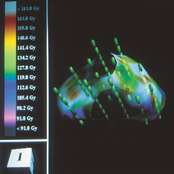 Brachytherapist for Prostate Cancer