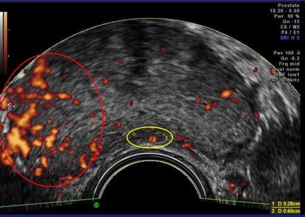Color Doppler untrasound result