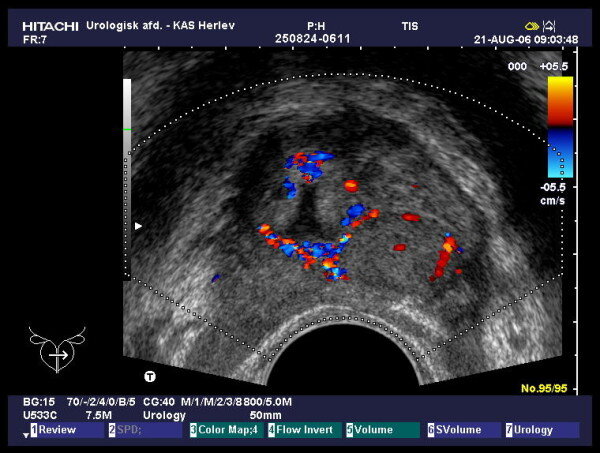 Color Doppler untrasound result