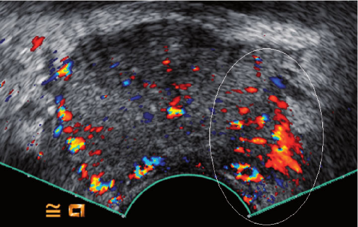 Color Doppler untrasound result